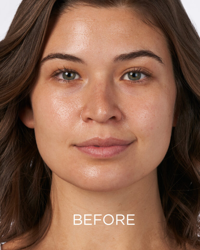 Bilde for sosiale medier NEOSTRATA Mandelic Clarifying Hydragel (før-bilde)