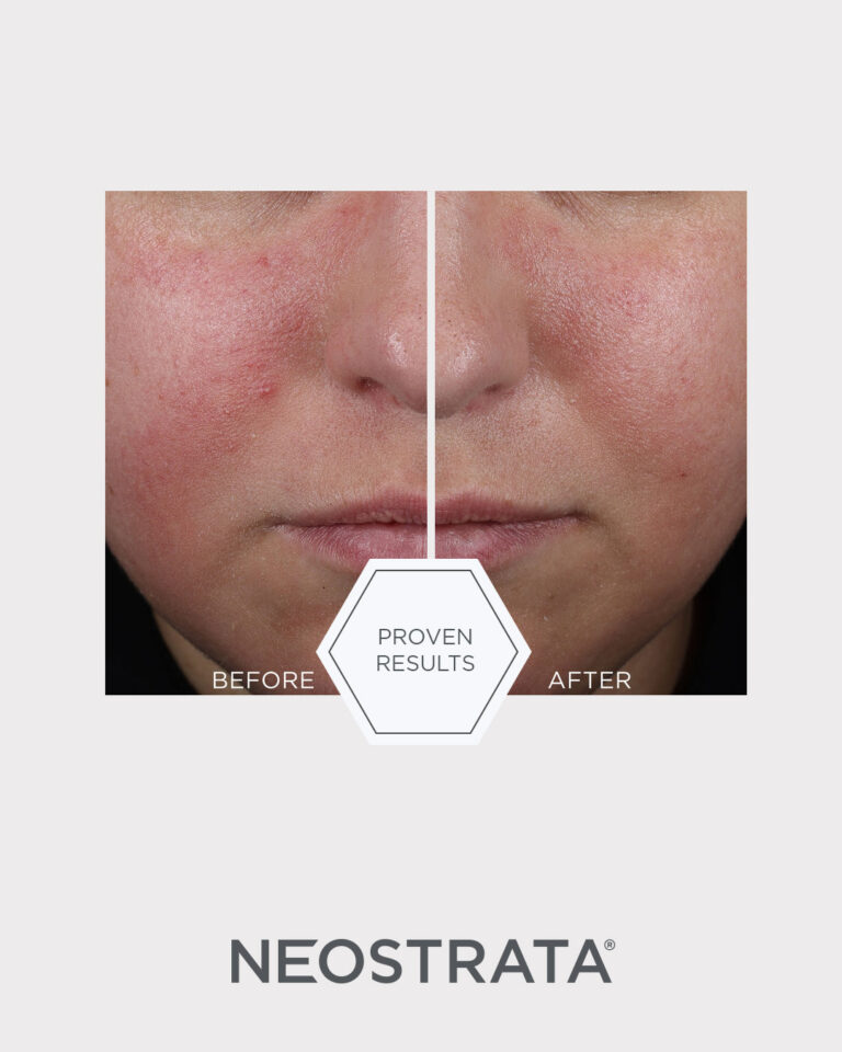 Bilde for sosiale medier NEOSTRATA Mandelic Clarifying Hydragel 1