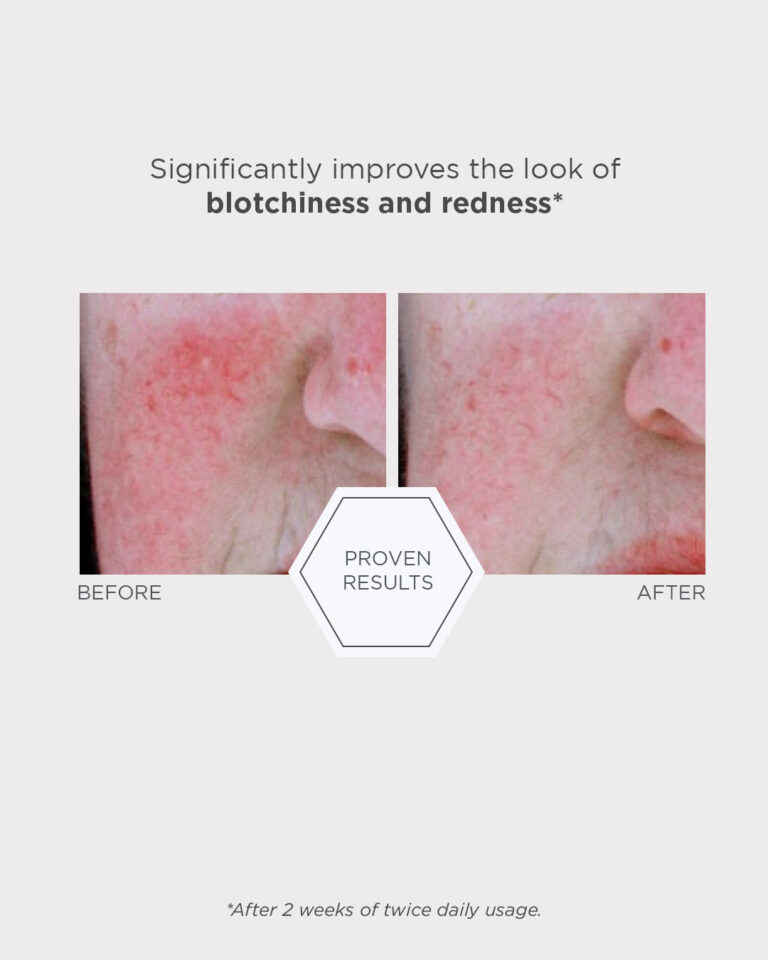 Bilde for sosiale medier NEOSTRATA Redness Neutralizing Serum 5