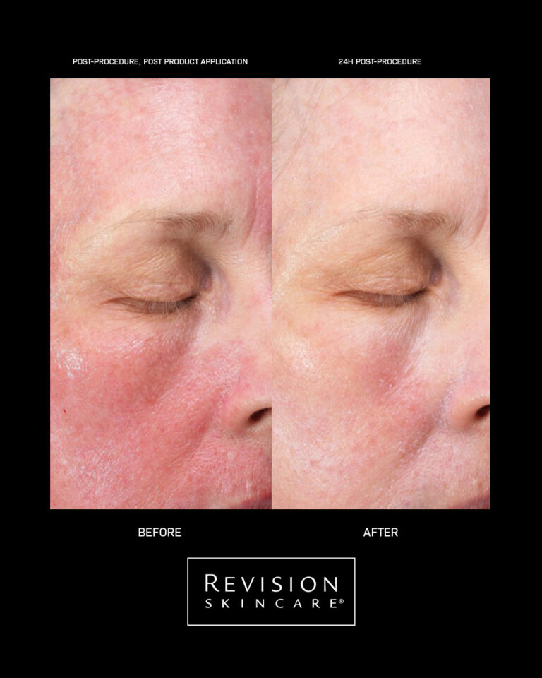 Bilde for sosiale medier Revision Skincare CMT results