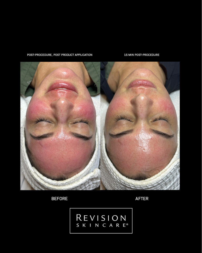 Bilde for sosiale medier Revision Skincare CMT results